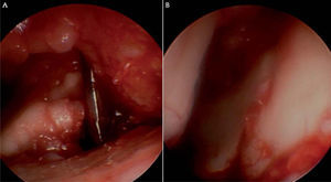– Imagen de artroscopia con la lente en el portal 6R. Se introduce por el portal 3-4 un periostótomo (A) y se levanta el fragmento hundido. Imagen final (B) de la articulación completamente restraurada.