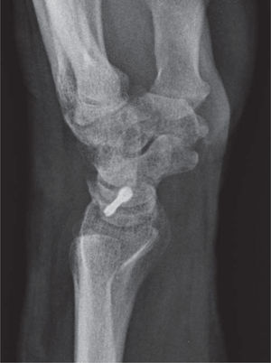 – Radiografía convencional lateral, en la que se muestra un procedimiento RASL con la dirección del tornillo hacia el dorso del semilunar, con el consiguiente riesgo de osteolisis y cut-out del implante.