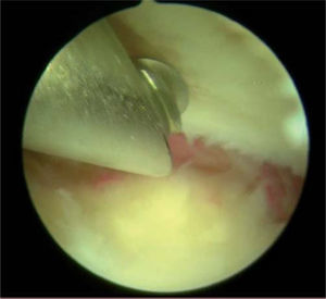 – Imagen artroscópica en la articulación radiolunar que muestra una fresa en el portal 3-4 iniciando la resección del semilunar en una carpectomía artroscópica.