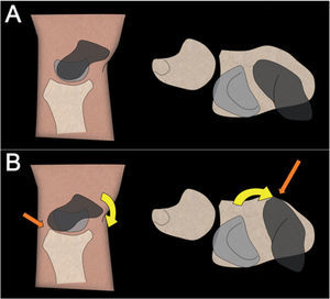 – A) Posición normal del escafoides. B) Posición del escafoides en una inestabilidad escafolunar. Se encuentra flexionado y pronado (flecha amarilla), lo que conlleva un conflicto en el margen dorsal del radio (flecha naranja).