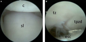 – Artroscopia de muñeca derecha; visión del portal MCR. A) Visión del polo proximal del hueso grande indemne. B) Identificación del portal STTR.