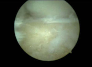 – Artroscopia de muñeca derecha. Visión del portal MCR. Resección del polo distal del escafoides.