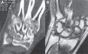 – Pseudoartrosis de escafoides en la muñeca izquierda con afectación mediocarpiana (SNAC III) en un paciente varón de 35 años. A) Tomografía computarizada. B) Resonancia magnética.