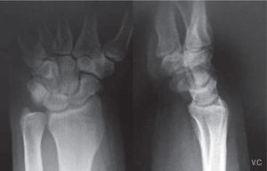– Radiografía simple anteroposterior y lateral de muñeca: ausencia de hallazgos significativos, posible disminución del espacio entre el polo proximal del ganchoso y el semilunar.