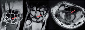 – Resonancia magnética: pinzamiento entre el polo proximal del hueso ganchoso y el semilunar, edema óseo en ambos y posible lesión del complejo del fibrocartílago triangular (CFCT).