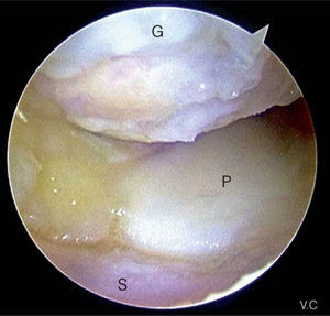 – Visión artroscópica de la lesión a nivel del polo proximal del ganchoso y en la superficie articular distal del semilunar. Visión mediocarpiana desde el portal mediocarpiano radial. G: ganchoso; P: piramidal; S: semilunar.