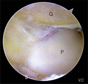 – Imagen final artroscópica tras la resección del polo proximal del ganchoso. Visión desde el portal mediocarpiano radial. G: ganchoso; P: piramidal; S: semilunar.