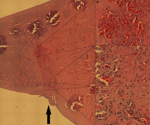 Corte axial del menisco medial del cerdo al nivel de la lesión meniscal (flecha negra) suturada. Tinción hematoxilina-eosina, ampliación original 20×. Pese a que han pasado solo 2 semanas, la curación de la lesión es evidente. Se aprecian zonas de neovascularización extensas (detalle A) en la zona de lesión mientras que a ambos lados de la zona lesionada estas no aparecen, confirmando que la lesión inicial se realizó en zona avascular. También se aprecia hipercelularidad evidente a expensas de fibrocondrocitos maduros en la zona lesionada (detalle B). Asimismo se aprecian en algunas localizaciones formaciones isogénicas de condrocitos (detalle C, círculos pequeños).