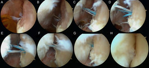 Técnica del remplissage. Se identifica la lesión de Hill-Sachs desde el portal anterosuperior (A), se realiza un portal accesorio posterolateral sobre el defecto (B), se coloca un implante con doble sutura en el borde medial del defecto y en la parte media craneocaudalmente (C), se pasa uno de los cabos de una sutura (rayada) por una punción tendinocapsular craneal a la inicial pero usando el mismo portal cutáneo (D), se pasa otro cabo de la otra sutura (azul) por una punción tendinocapsular caudal a la inicial pero usando el mismo portal cutáneo (E), se anudan ambas suturas progresivamente (F), primero la caudal (G) y luego la craneal (H).