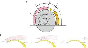 Clasificación de Patte18 para roturas del manguito rotador. A) En el plano sagital se divide en 6 zonas. Segmento 1: rotura del tendón subescapular (SB). Segmento 2: rotura en el ligamento coracohumeral. Segmento 3: rotura del tendón supraespinoso (SE). Segmento 4: rotura del tendón SE y de la parte más superior del tendón infraespinoso (IE). Segmento 5: rotura del tendón SE e IE. Segmento 6: rotura de los tendones SB, SE e IE. B) En el plano coronal se clasifican en 3 tipos. Tipo 1: no retraída. Tipo II: retraída a nivel de la cabeza humeral. Tipo III: retraída a nivel de la glena.