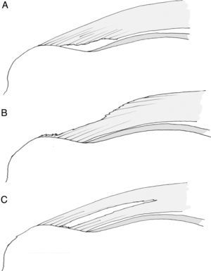 Clasificación de lesiones parciales: articular (A), bursal (B) o intratendinosa (C).