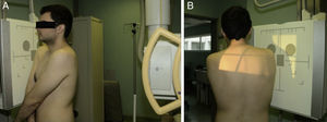 Esta figura muestra cómo obtener una proyección de Alexander24. El paciente coloca el brazo sano cruzando el pecho y los hombros proyectados hacia delante. A) Visión anterolateral. B) Visión posterolateral.