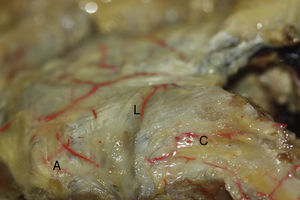 Visión anteroposterior de la articulación acromioclavicular. Ligamento acromioclavicular superior reforzando la capsular superior de la articulación acromioclavicular. A: acromion; C: clavícula; L: ligamento acromioclavicular superior.