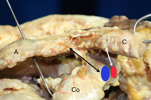 Visión anteroposterior del tercio distal de una clavícula derecha. El ligamento trapezoide (flecha negra) es cuadrado y grueso y se dispone anterolateral respecto al ligamento conoide (flecha blanca) que es triangular, menos grueso y tiene un recorrido más vertical. La inserción del ligamento trapezoide a nivel de la coracoides es en el borde interno del ángulo de la misma (área azul); mientras que el ligamento conoide se inserta en la parte posteromedial de la raíz de la apófisis coracoides (área roja). A: acromion; C: clavícula; Co: coracoides.
