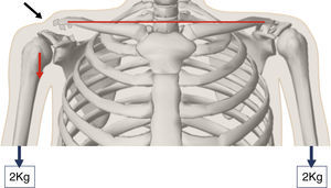 Imagen que muestra el desplazamiento inferior del brazo al producirse una luxación acromioclavicular tipo iii, lo que produce una deformidad en la piel aparente (flecha negra). Al colocar 2kg el desplazamiento del brazo es mayor y la deformidad se hace más prominente.