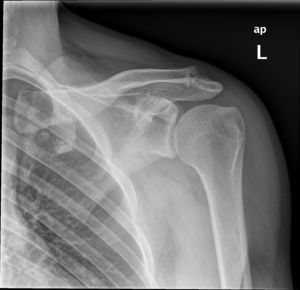 Radiografía anteroposterior de hombro izquierdo con artrosis acromioclavicular de hombro izquierdo. Obsérvese la hipertrofia de la articulación y la disminución del espacio articular.