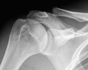 Radiografía anteroposterior de hombro derecho con una osteolisis del extremo distal de la clavícula. Obsérvese la rarefacción irregular del borde lateral de la clavícula. Ocasionalmente pueden observarse calcificaciones punteadas en la zona osteolítica.