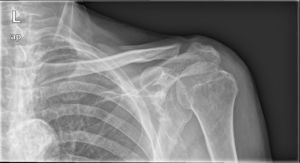 Radiografía anteroposterior de hombro izquierdo con artrosis acromioclavicular de hombro izquierdo tratada mediante resección artroscópica. La resección ideal es controvertida pero debe permitir un movimiento de la articulación acromioclavicular sin pinzamiento residual.