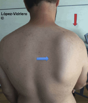 Paciente con luxación acromioclavicular grado iii en el hombro derecho (flecha roja), que a la exploración física presenta disquinesis escapular homolateral. Se objetiva claramente la protrusión del borde inferior de la escápula derecha (flecha azul).