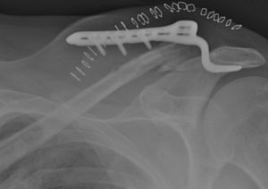 Radiografía simple AP de clavícula izquierda: se aprecia el fracaso de una placa gancho en una fractura distal de clavícula, con aflojamiento de los tornillos y movilización del material.