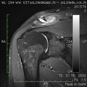Imagen de resonancia magnética en corte coronal con secuencia fat sat. Se aprecia en la AAC edema óseo endomedular, líquido articular y sinovitis capsular.