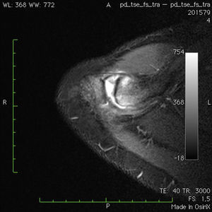 Imagen de resonancia magnética en corte trasversal con secuencia fat sat. Se aprecia edema óseo endomedular, líquido articular y sinovitis capsular.