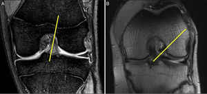 A. Imagen coronal de RMN con rodilla en extensión. Se aprecia la orientación más vertical del LCA sano. B. Imagen de RMN con rodilla a 90°. Se observa la oblicuidad del LCA sano y su inserción en la parte posterior de la pared medial del cóndilo femoral externo y la proximidad con el cartílago articular. Esta imagen corresponde a la imagen artroscópica durante la cirugía con la rodilla a 90° de flexión.