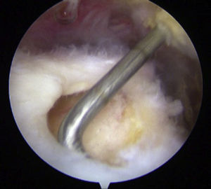 Medición intraoperatoria de rotura del supraespinoso con sonda graduada.