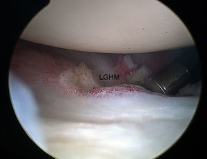 Liberación de la cápsula anterior y del ligamento glenohumeral medio en un hombro izquierdo empleando el portal posterior para la visión y el ASPL para la instrumentación. LGHM: ligamento glenohumeral medio.