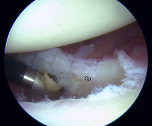 Liberación de la cápsula posterior en un hombro izquierdo empleando el portal anterior para la visión y el ASPL para la instrumentación. Cp: porción posterior de la cápsula.