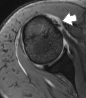 Corte axial de IRM del hombro derecho donde se aprecia a nivel de la corredera bicipital 2 señales correspondientes a la duplicidad de la PLB (flecha).
