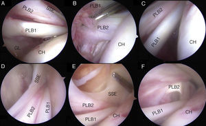 Secuencia fotográfica de artroscopia de hombro derecho. Paciente en decúbito lateral, vista a través de óptica de 30° en portal posterior. En recuadro A se observa la porción larga del bíceps en su origen en el tubérculosupraglenoideo (PLB1), por sobre ella las fibras accesorias provenientes del tendón del músculo supraespinoso (SSE), que son el origen de la PLB accesoria duplicada (PLB2), además de la glena (GL) y la cabeza humeral (CH). En recuadro B se puede observar desde la misma visión la PLB1 elevada con instrumental, mostrando la salida de estas fibras accesorias del SSE que dan origen a la PLB2. EL recuadro C muestra el ascenso de la visión acompañando las fibras de la PLB2 provenientes del SSE que discurren por sobre la PLB1. Los recuadros C y D muestran cómo la PLB2 accesoria discurre entre elSSE y la PLB1 hacia la corredera bicipital, así como también el «foot print» del SSE en la CH. El recuadro E presenta la PLB2 traccionada y elevada por instrumental, observando de mejor manera las fibras originales del SSE y la conformación de la PLB2 que ingresa a la corredera junto a la PLB1.