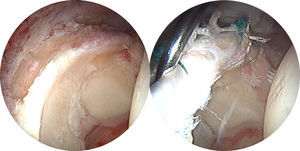 Imagen artroscópica de un caso de ausencia de labrum tratado con injerto de labrum de fascia lata.