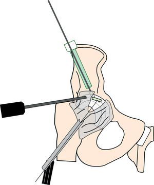 Muestra la disposición de los diferentes portales e instrumental para la realización de una técnica autologous matrix induced chondrogenesis (AMIC) con membrana en una cadera derecha.