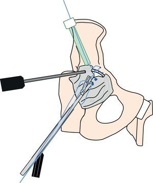 Muestra la disposición de los diferentes portales e instrumental para la realización de la técnica de reconstrucción capsular anatómica en una cadera derecha mediante un anclaje 5-8 mm sobre la reinserción del labrum y 2 suturas de convergencia de márgenes.