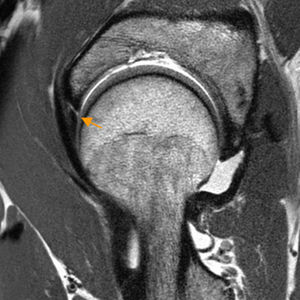 Rotura del labrum. El corte sagital en densidad protónica de artrografía-RM de cadera derecha demuestra una rotura de la base del labrum (flecha naranja) con separación completa del labrum respecto al cartílago y el acetábulo correspondiente a una rotura tipo I de Seldes.