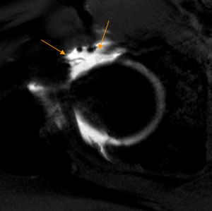 Defecto capsular. El corte axial T1 de artrografía-RM de cadera derecha demuestra un amplio defecto de la cápsula anterior (flechas naranjas) residual a artroscopia previa.