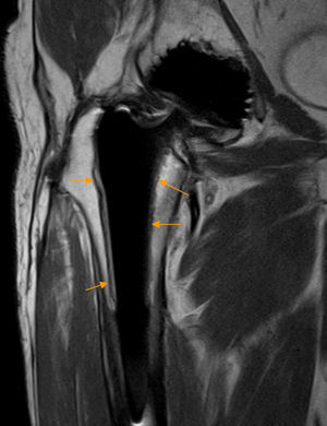 Osteolisis aséptica en prótesis de cadera. El corte coronal en densidad protónica de RM de cadera y fémur proximal derecho demuestra un área de osteolisis bordeando al vástago femoral (flechas naranjas), más evidente en la superficie externa del vástago, caracterizada por una banda de hiperseñal delimitada superficialmente por una fina capa hipointensa.