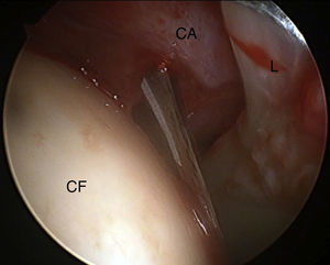 Capsulotomía anterior en seco con bisturí artroscópico en abordaje todo dentro (cadera derecha). CA: cápsula articular; CF: cabeza femoral; L: labrum.