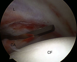 Capsulotomía lateral con bisturí artroscópico en abordaje todo dentro (cadera derecha). CA: cápsula articular; CF: cabeza femoral; L: labrum.
