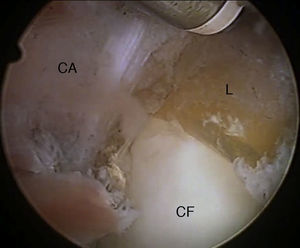 Capsulotomía anterior con terminal de radiofrecuencia en abordaje fuera-dentro (cadera izquierda). CA: cápsula articular; CF: cabeza femoral; L: labrum.