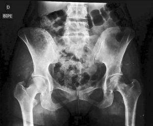 Radiografía AP de pelvis en bipedestación.