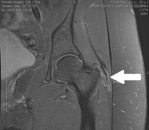 RMN corte coronal: afectación en la inserción del tendón del glúteo.