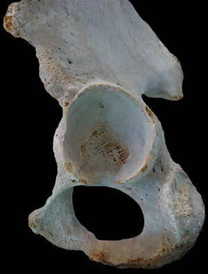 Anatomía ósea acetabular como resultado de la fusión de los centros de osificación del isquion, ilion y pubis.