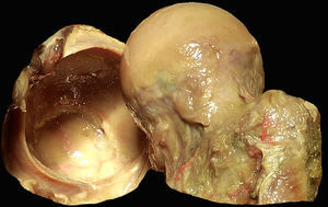 Anatomía macroscópica de la articulación coxofemoral. Se sitúa la cabeza femoral con el cartílago articular (derecha) y la cavidad acetabular con el labrum en herradura a lo largo del reborde acetabular (izquierda). El cierre del labrum en la zona inferior se realiza por el ligamento transverso.