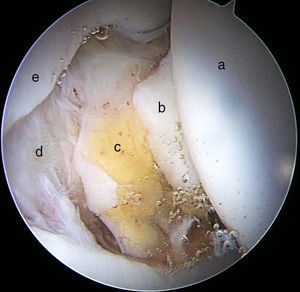 Imagen artroscópica de cadera derecha. Visión desde portal anterolateral distal. Cabeza femoral a), ligamento redondo b), grasa pulvinar c), fosita semilunar d) y cartílago acetabular e).