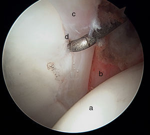 Imagen artroscópica de cadera derecha. Visión desde portal anterolateral. Cabeza femoral a), triángulo capsular anterior b), labrum anteroinferior c) y sulcus sublabral d).