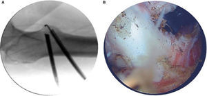 A y B) Visión del abordaje del tendón del psoas a nivel del trocánter menor en intensificador de imágenes y por vía endoscópica.