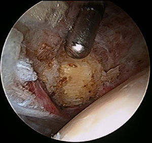 Localización del tendón del psoas a través del compartimento central en una cadera izquierda.