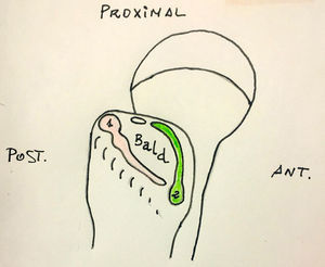 Inserciones de los tendones glúteo medio (1) y menor (2).